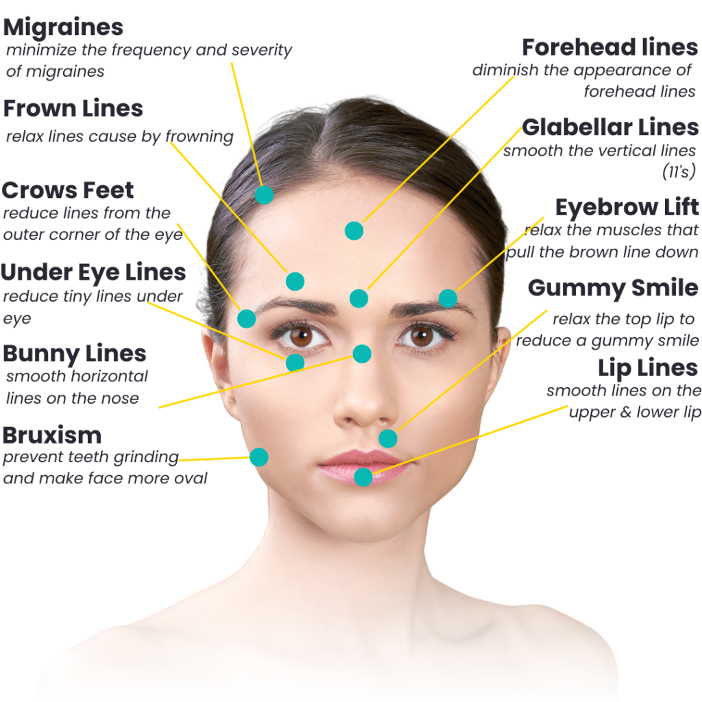 Areas for botox